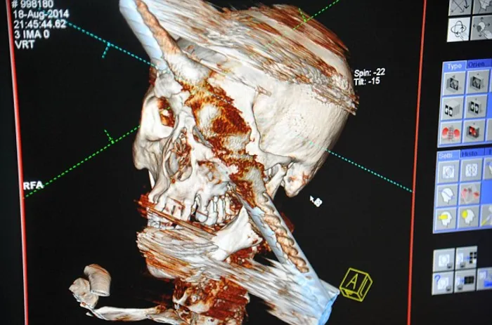 Chinese man survive metal bar goes right through the head