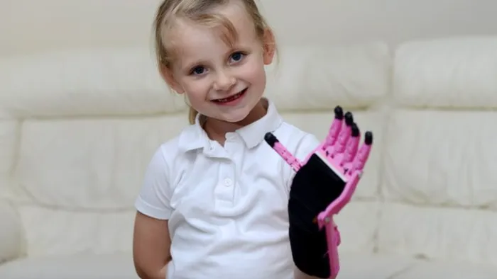 Inverness girl Hayley Fraser gets 3D-printed hand