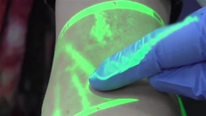 This Gadget Reveals Exactly Where Veins Are, So Nurses Don't Stab You Blindly