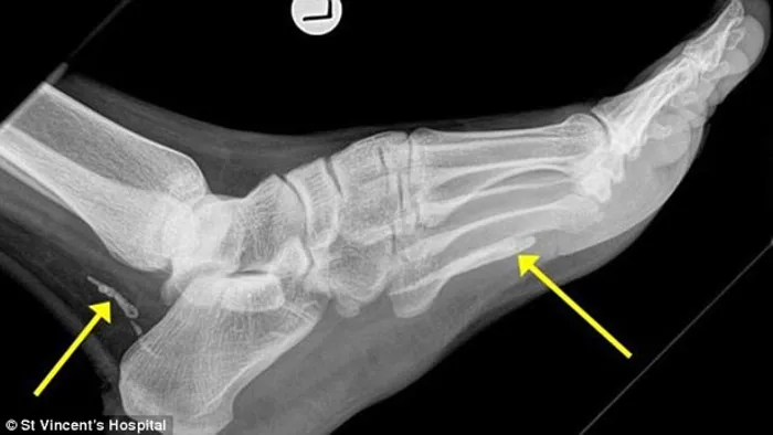 Metre-long worm living in foot for at least four years